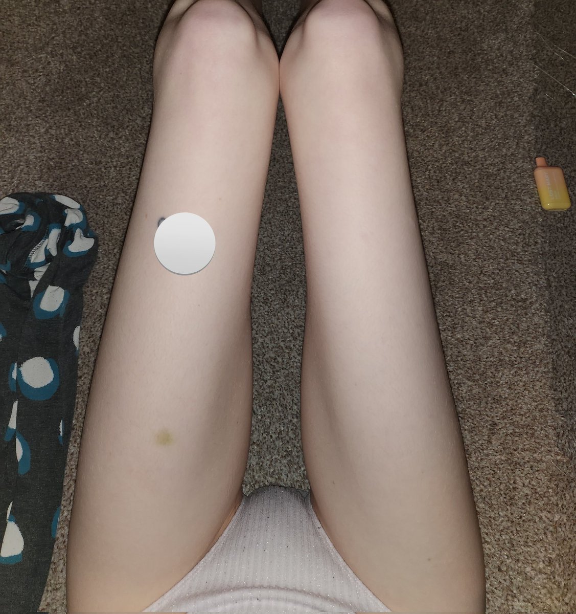greyhoundass's tweet photo. Everything that helped me go from:
◇bmi 17s > 15.0◇
In just over one month. 
A 🧵 for edtwt
(Disclaimer: It's only my experience, and what works best for me, may not for you.) https://t.co/XNjzggjFO8