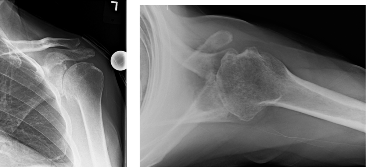 MillettMD's tweet photo. Are you looking to delay a total shoulder replacement?
Dr. Millett has created an alternative for young active patients w/advanced #osteoarthritis. The comprehensive arthroscopic management (CAM) procedure is an innovative treatment technique that delays #TotalShoulderReplacement https://t.co/q9W0fX4DDj