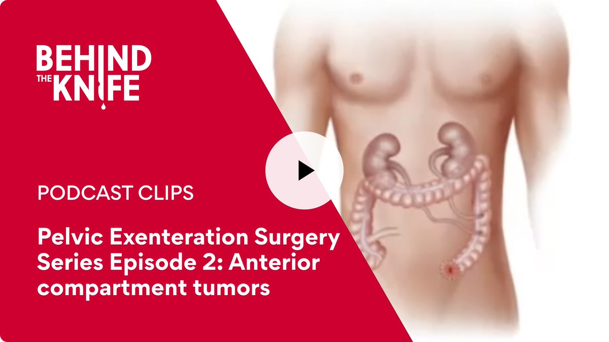 Don't miss part 2 of our Pelvic Exenteration Surgery series: behindtheknife.org/podcast/pelvic… 📹 and/or 🎧 We love the 🌎 collaboration with @RPA_IAS @SOuRCe_RPA @KilianBrown3 @paulo_sutt @TheChristieNHS