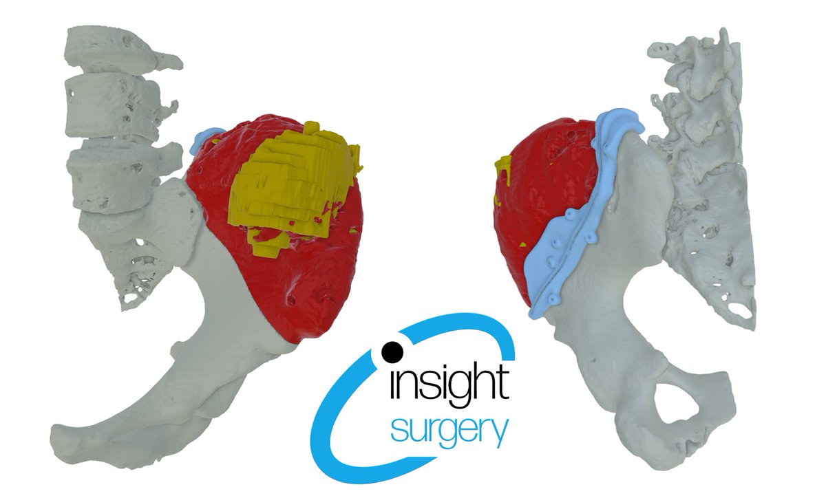 Treating Mafucci syndrome, a rare disorder characterized by cartilage overgrowths and skeletal deformities, at @RNOHnhs  using PSI guides, to achieve a highly accurate biplanar osteotomy.  Targeting pathological bone while preserving sacral continuity.

#Innovation #Orthopedics