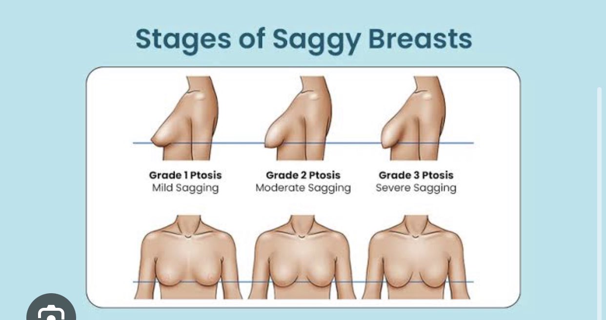 Dr Kelechi Okoro, Ebonyi Babe on X: NO CREAM OR PILLS CAN PREVENT OR UNDO  BREAST SAGGING. The only way to reverse breast sagging is through surgery:  Breast Lift
