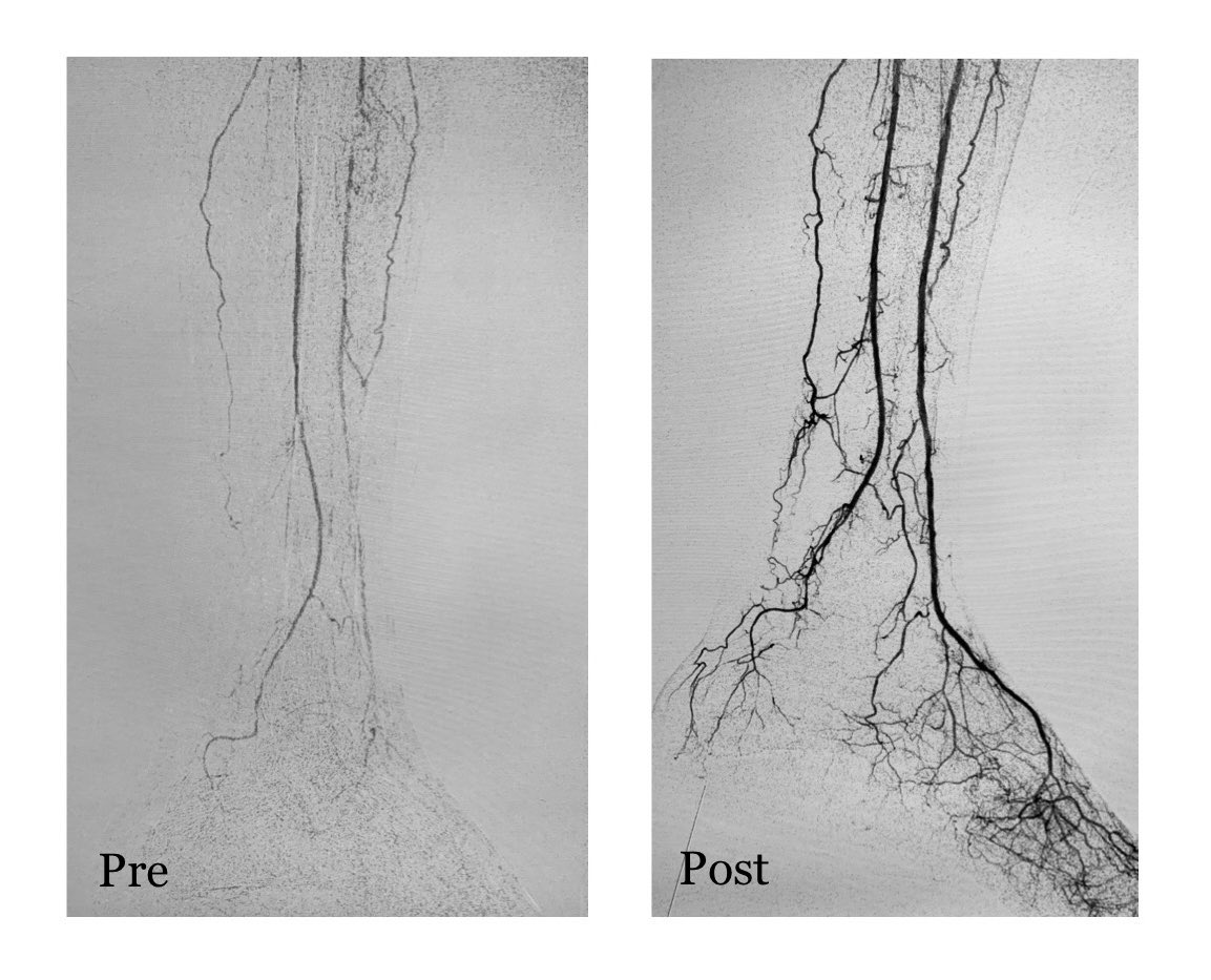 Karan Anandpara (@karananandpara) on Twitter photo Improving the inflow + outflow. CTLI; Rutherford VI; SFA + BTK disease; SFA stenting and ATA, TP trunk and Peroneal plasty done
.
#irad #MedTwitter #MedEd #MedX #interventionalradiology <a href="/SIRRFS/">SIR RFS</a> <a href="/SIR_ECS/">SIR ECS</a> <a href="/SIRspecialists/">Society of Interventional Radiology</a> <a href="/cirsesociety/">CIRSE</a> <a href="/Arabjir/">The Arab Journal of Interventional Radiology</a> <a href="/_backtable/">BackTable Vascular and Interventional</a> <a href="/BSIR_News/">The British Society of Interventional Radiology</a> <a href="/Applied_Rad/">AppliedRadiology</a> Improving the inflow + outflow. CTLI; Rutherford VI; SFA + BTK disease; SFA stenting and ATA, TP trunk and Peroneal plasty done
.
#irad #MedTwitter #MedEd #MedX #interventionalradiology <a href="/SIRRFS/">SIR RFS</a> <a href="/SIR_ECS/">SIR ECS</a> <a href="/SIRspecialists/">Society of Interventional Radiology</a> <a href="/cirsesociety/">CIRSE</a> <a href="/Arabjir/">The Arab Journal of Interventional Radiology</a> <a href="/_backtable/">BackTable Vascular and Interventional</a> <a href="/BSIR_News/">The British Society of Interventional Radiology</a> <a href="/Applied_Rad/">AppliedRadiology</a>