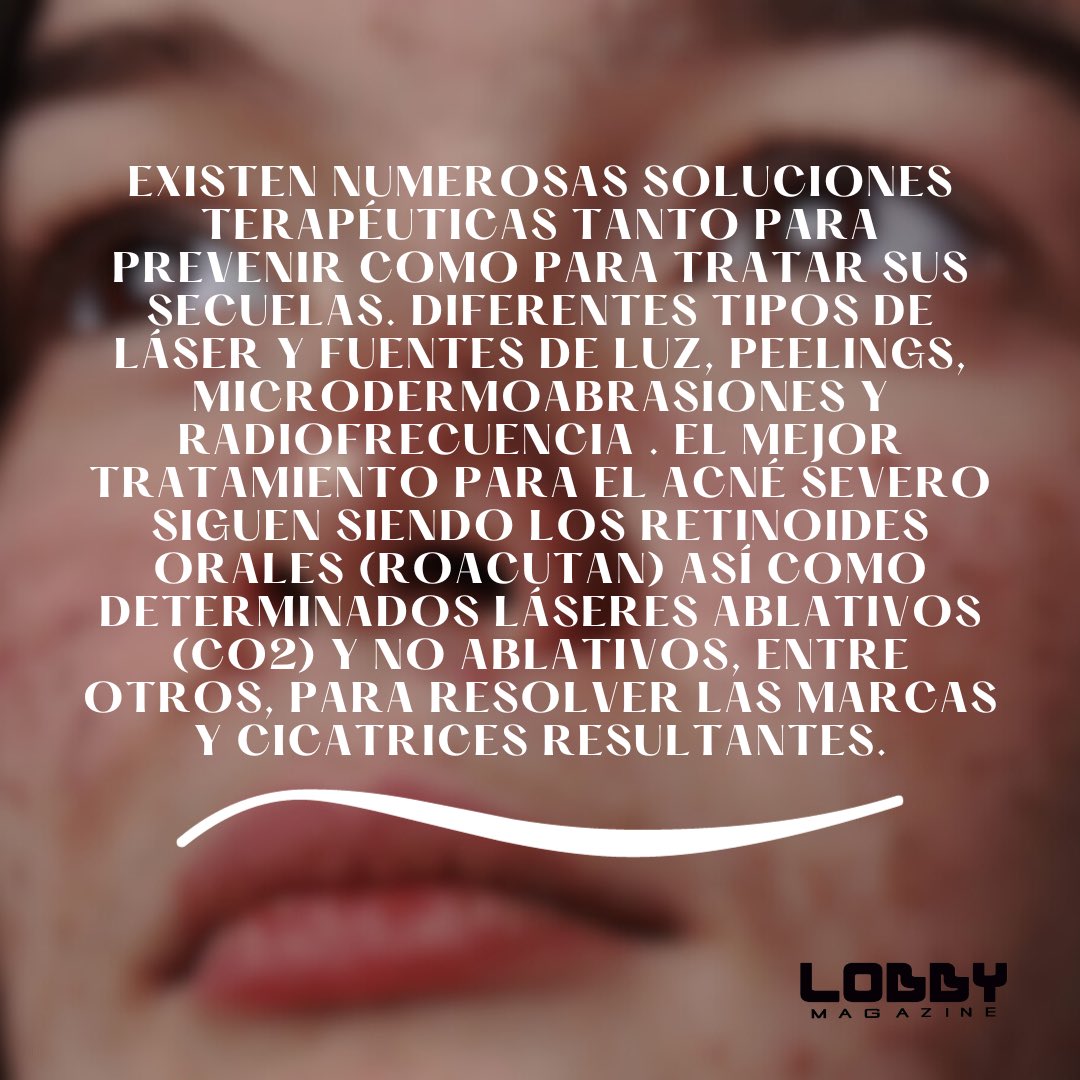#lobbymagazine #lobbymagazinerd #larevistadeleste
#acnéjuvenil #piel #acné #pubertad #hijos #adolescencia