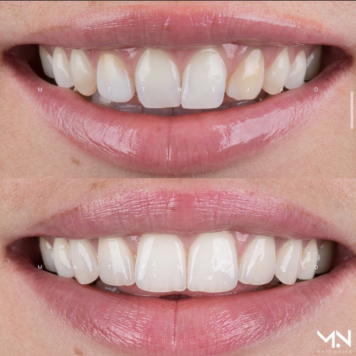 Great veneers are worth the price of admission. This is some work by Matt Nejad (based in LA). 

No one goes up to this person and asks where they got their teeth done because well…

They look like her teeth just..better.