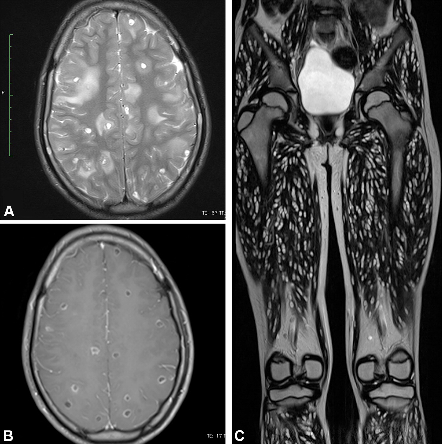 Frontiers | Breakouts—A Radiological Sign of Poor Prognosis in Patients  With Brain Metastases