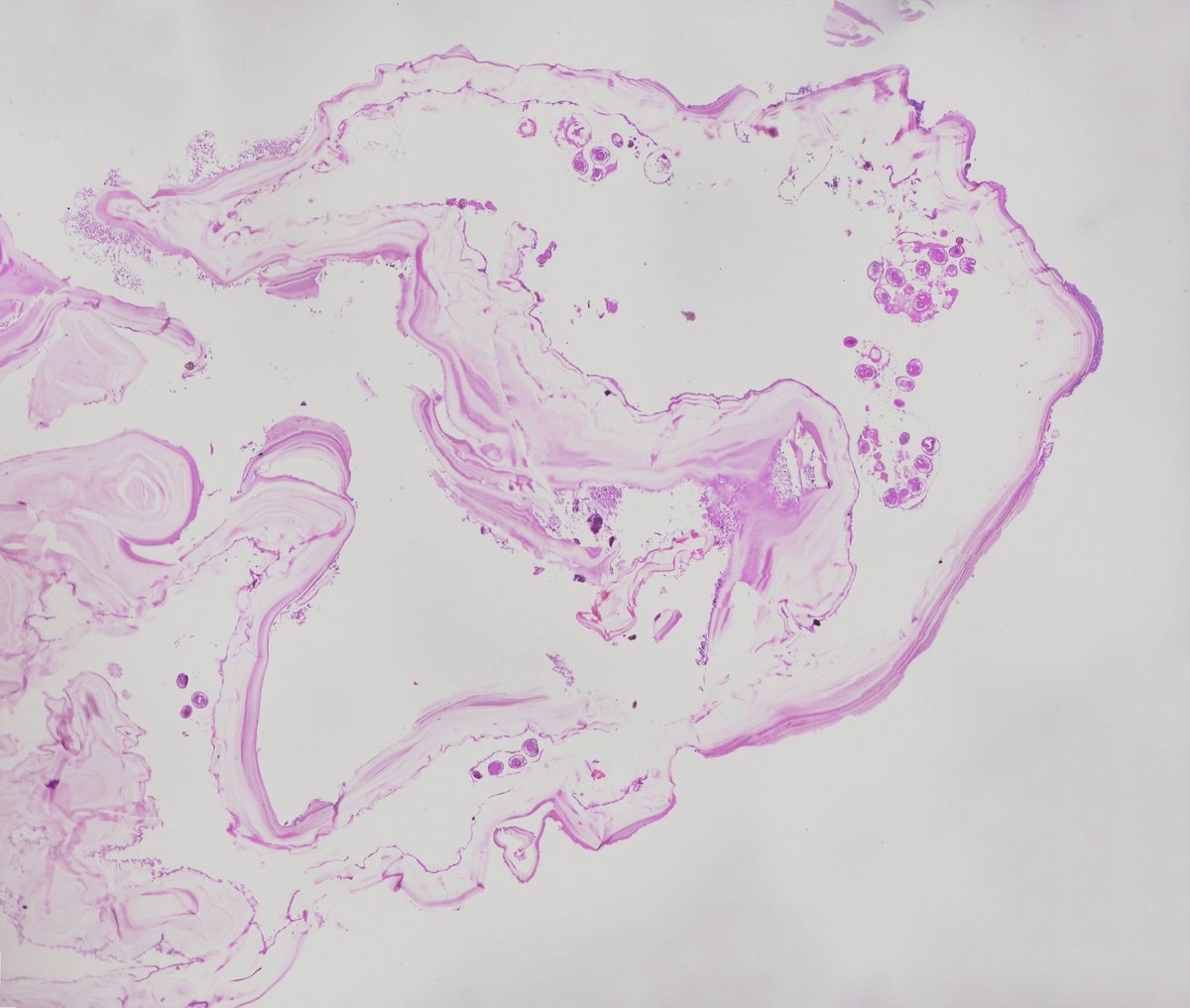Drmerm's tweet photo. Hydatid Cyst, Liver
A cross section of a scolex surrounded by laminated membrane lining the hydatid cyst.
#PathTwitter
#GIpath 
#pathology 
#MedTwitter 
#liver https://t.co/8QDuanHDMQ