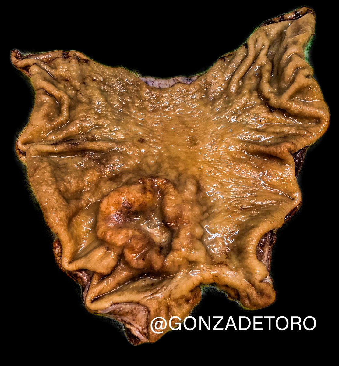 gonzadetoro's tweet photo. #Pathology #PathTwitter #GIPath  Cool case @Irene_Gullo @SurgicalPath @Pathmath1 @RaulSGonzalezMD @vi_monappa @DrJuhlin @Cristina_VargAP @Tinabaillie22 @vij_mukul @01sth02 @DrCycloPath @PancPathologist @RunjanChetty @Mvgs1706 @ALBoothMD @drtimbracey https://t.co/u9G5YKMJw2