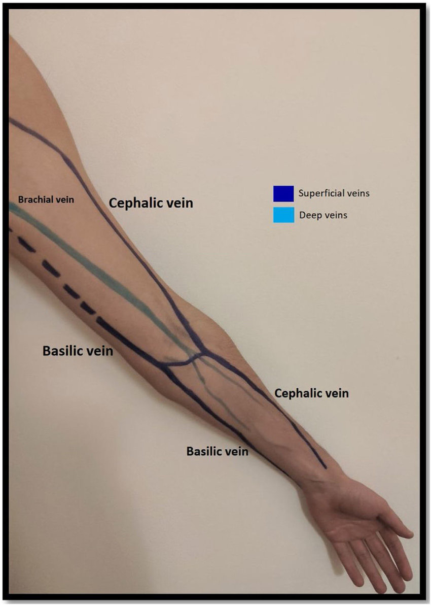 Venous #anatomy of the upper limb. Useful for #POCUS guided cannulation/venous mapping prior to #dialysis access placement. #FOAMed #MedEd 
🔗researchgate.net/publication/34…