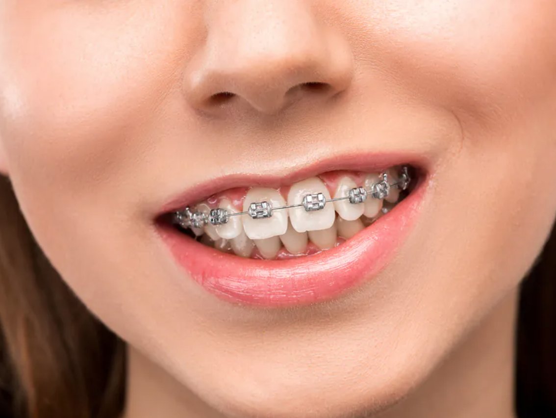 dentistnearyou's tweet image. How to Fix an Overbite suredental.com.au/how-to-fix-an-… #overbite #orthodontics #braces #brisbane #metalbraces #brisbanedentist