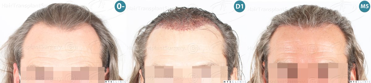 Hairtransplant_ tweet picture