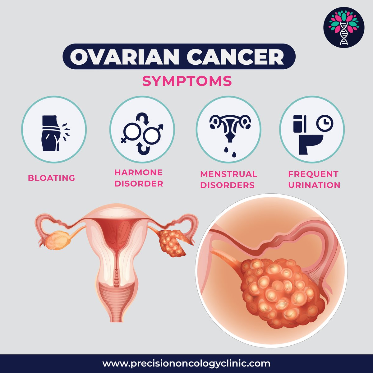 Precision_Onco's tweet photo. Ovarian cancer symptoms can be subtle and easily overlooked. Detecting them early is crucial for effective treatment. Early diagnosis and prompt medical attention play a key role in improving outcomes for ovarian cancer patients.

#ovariancancersymptoms  #Precisiononcologyclinic https://t.co/OA0lPoXInN