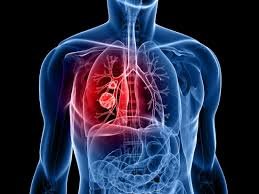 SimplyBecca_'s tweet photo. CAUSES OF LUNG CANCER

Bola Tinubu Fubara Pete Edochie EFCC Smash Binance #AOU Deborah Egypt Rufai #BBUK Rivers Victor Osimhen Phyna Ilebaye mercy Bella pere Adekunle CEEC Beauty Sheggz Sam Larry Naira Marley seyi Tinubu morravey
Princess whitemoney #RHOLagos #somgel Angel soma https://t.co/QFb7FvavwS