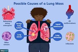 SimplyBecca_'s tweet photo. CAUSES OF LUNG CANCER

Bola Tinubu Fubara Pete Edochie EFCC Smash Binance #AOU Deborah Egypt Rufai #BBUK Rivers Victor Osimhen Phyna Ilebaye mercy Bella pere Adekunle CEEC Beauty Sheggz Sam Larry Naira Marley seyi Tinubu morravey
Princess whitemoney #RHOLagos #somgel Angel soma https://t.co/QFb7FvavwS