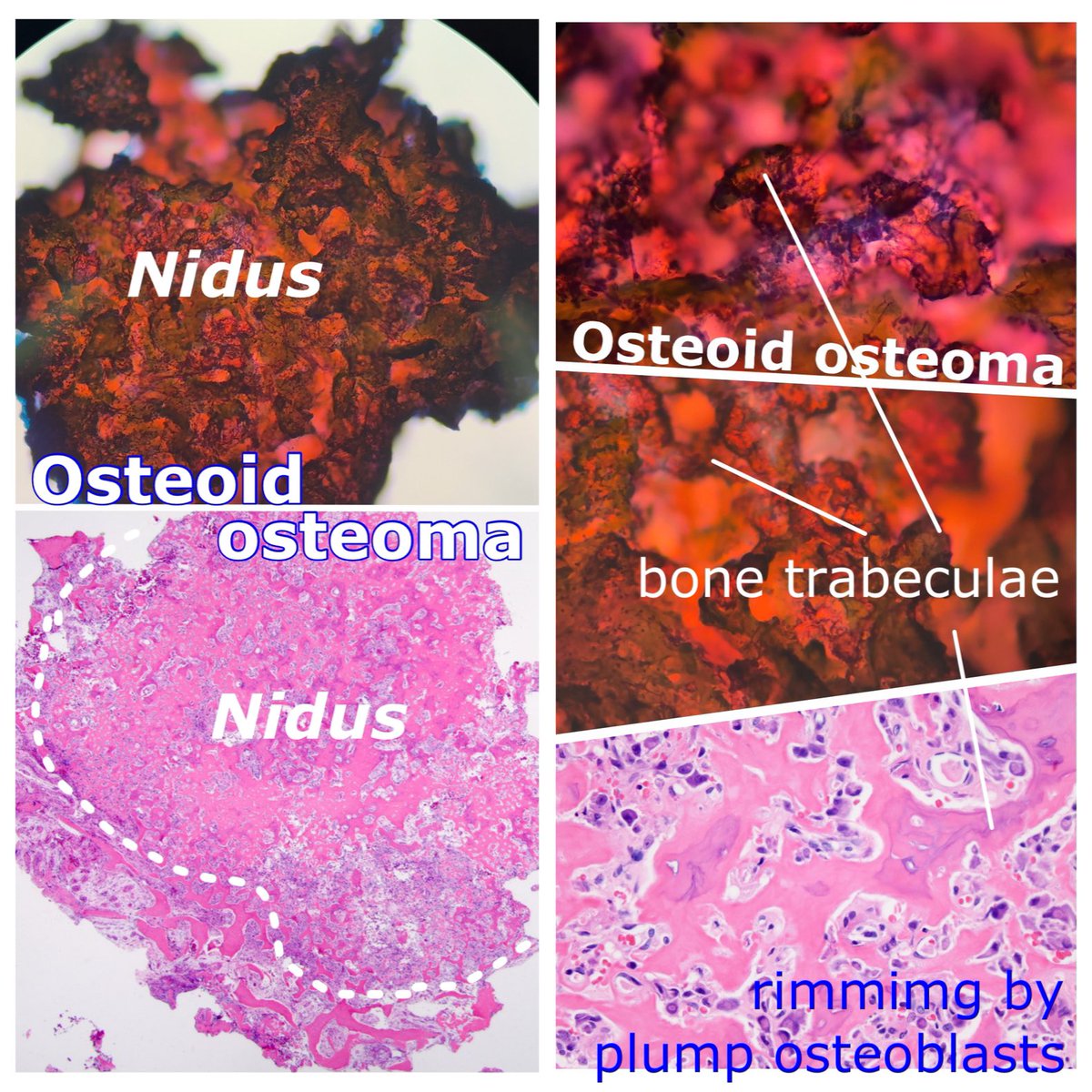 kyokoy_v's tweet photo. Osteoid osteoma. 類骨骨腫.
https://t.co/YPHjAqDns5
#病理 #bstpath #細胞診 #histopathology #pathology #cytology #骨軟部細胞診 https://t.co/p2hX1mG7Gc