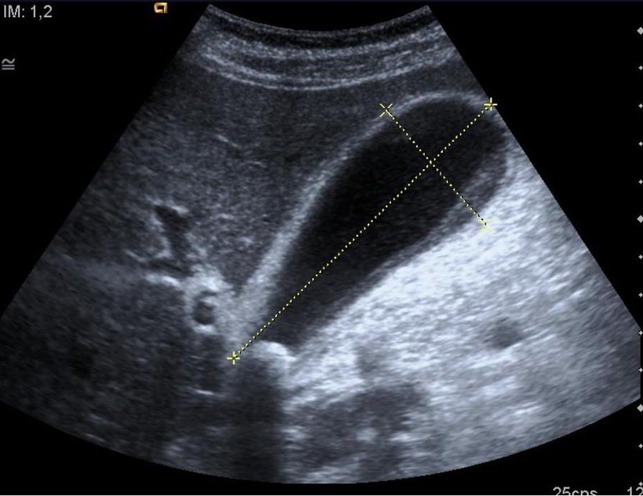 RutgersNJMS_POCUS (@rutgerspocus) on Twitter photo Gallbladder hydrops: size of GB  > 4 cm (transverse) x > 9 cm (longitudinal)
• Most commonly caused by impacted gallstones (at neck) 
• Prolonged blockage of cystic duct leads to increased intraluminal pressure,  inflammation
> High suspicion of cholecystitis (surgery consult) Gallbladder hydrops: size of GB  > 4 cm (transverse) x > 9 cm (longitudinal)
• Most commonly caused by impacted gallstones (at neck) 
• Prolonged blockage of cystic duct leads to increased intraluminal pressure,  inflammation
> High suspicion of cholecystitis (surgery consult)