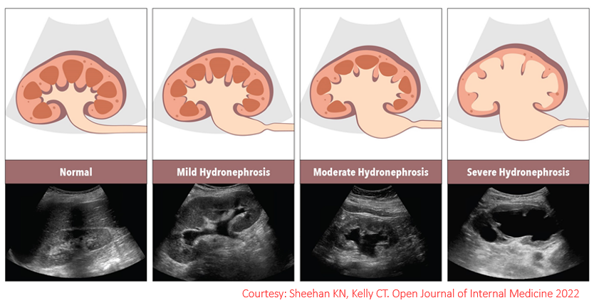 Qualitative grading of #hydronephrosis👇
#MedEd #Nephpearls #FOAMed