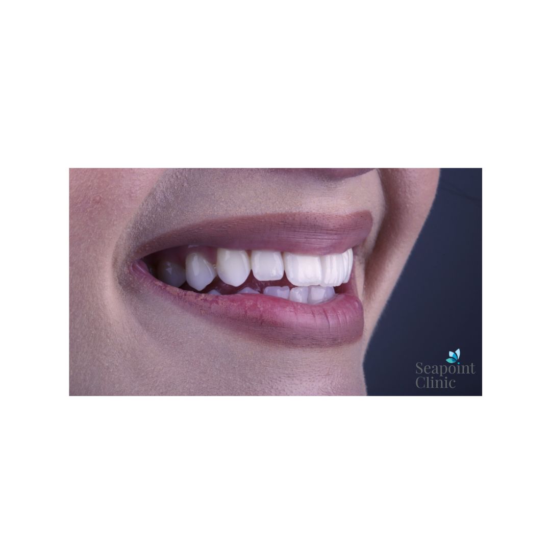 SeapointClinic's tweet photo. Beth's beautiful smile achieved with Orthodontic Treatment and our In-House Whitening. If you are considering the same path, book your appointment now : https://t.co/Te8KLfkPux
#dentistry #cosmeticdentistry #orthodontics #whitening https://t.co/zizTb691yB
