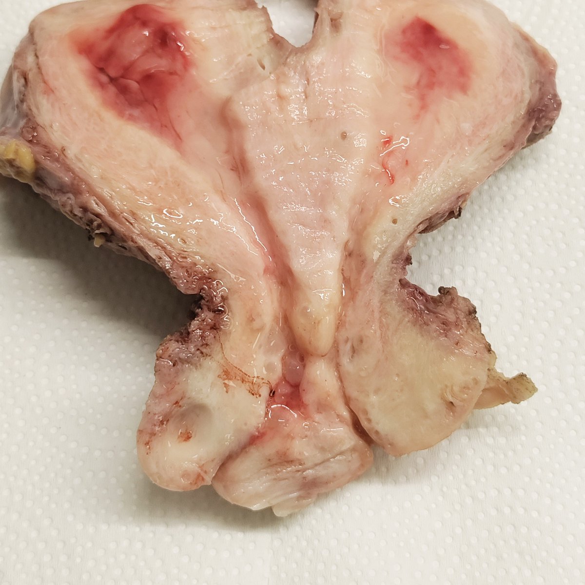 ASADDIWAN1's tweet photo. Uterus didelphys a rare congenital condition, commonly called a double uterus. #GynPath  @UMichPath  @CaDxPath  @TeamCaptainJohn 
@KayParkMD @Roma_GYNPath @AnneMillsMD @KMirza @sahar0493 @ahsanuitis
 #TwitterHomework #PathElective https://t.co/wAhkVgUyVK