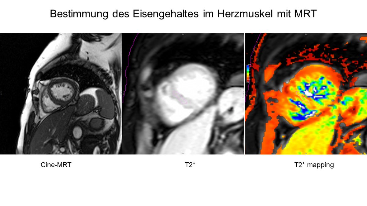 Deutsches Zentrum für Herzinsuffizienz (@dzhi_wuerzburg) on Twitter photo Wir sind bei Entschlüsselung der Wirkmechanismen der #SGLT2-Hemmer einen entscheidenden Schritt weitergekommen: Positive Auswirkungen der Empagliflozin-Behandlung bei #Herzinsuffizienz könnte mit Effekten auf #Eisenmetabolismus zusammenhängen <a href="/CEAngermann/">Christiane E. Angermann</a> ukw.de/aktuelle-meldu… Wir sind bei Entschlüsselung der Wirkmechanismen der #SGLT2-Hemmer einen entscheidenden Schritt weitergekommen: Positive Auswirkungen der Empagliflozin-Behandlung bei #Herzinsuffizienz könnte mit Effekten auf #Eisenmetabolismus zusammenhängen <a href="/CEAngermann/">Christiane E. Angermann</a> ukw.de/aktuelle-meldu…