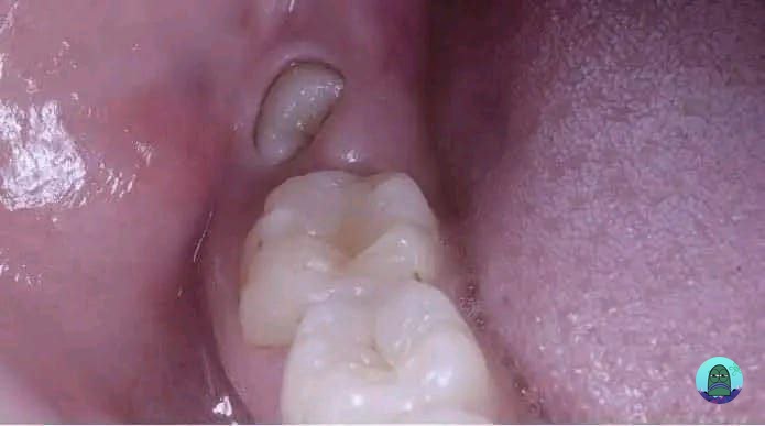 tanyakanrl's tweet image. 💚 TW CW // Gigi , jijik 

F23, tmbuh gigi geraham seperti ini. Sudah 2 bulan gbs makan sepuasnya, tiap bangun tidur sllu disambut sm sakit gigi😭 
Yg punya pnglman prnh cabut/operasi ini, kira2 biayanya brp dan brp hari bisa normal stlh operasi?
Cr on fb