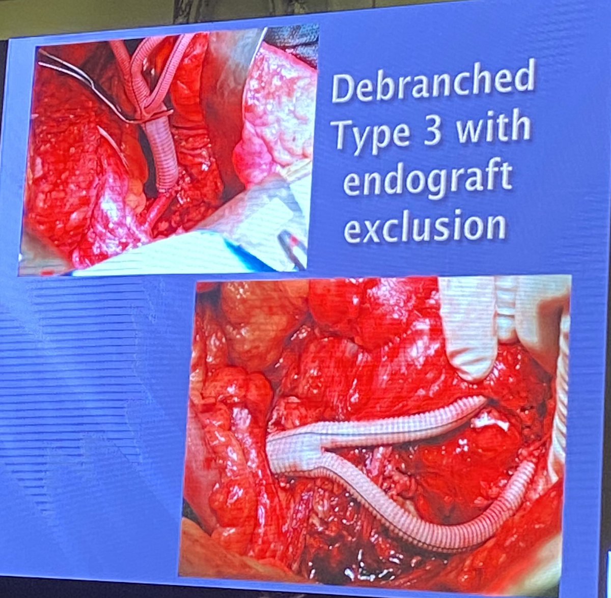 Rod White at East Meets West ISEVS in Bucharest, Romania- Evolving Patterns in Treatment of Acute Dissections of the Thoracic Aorta