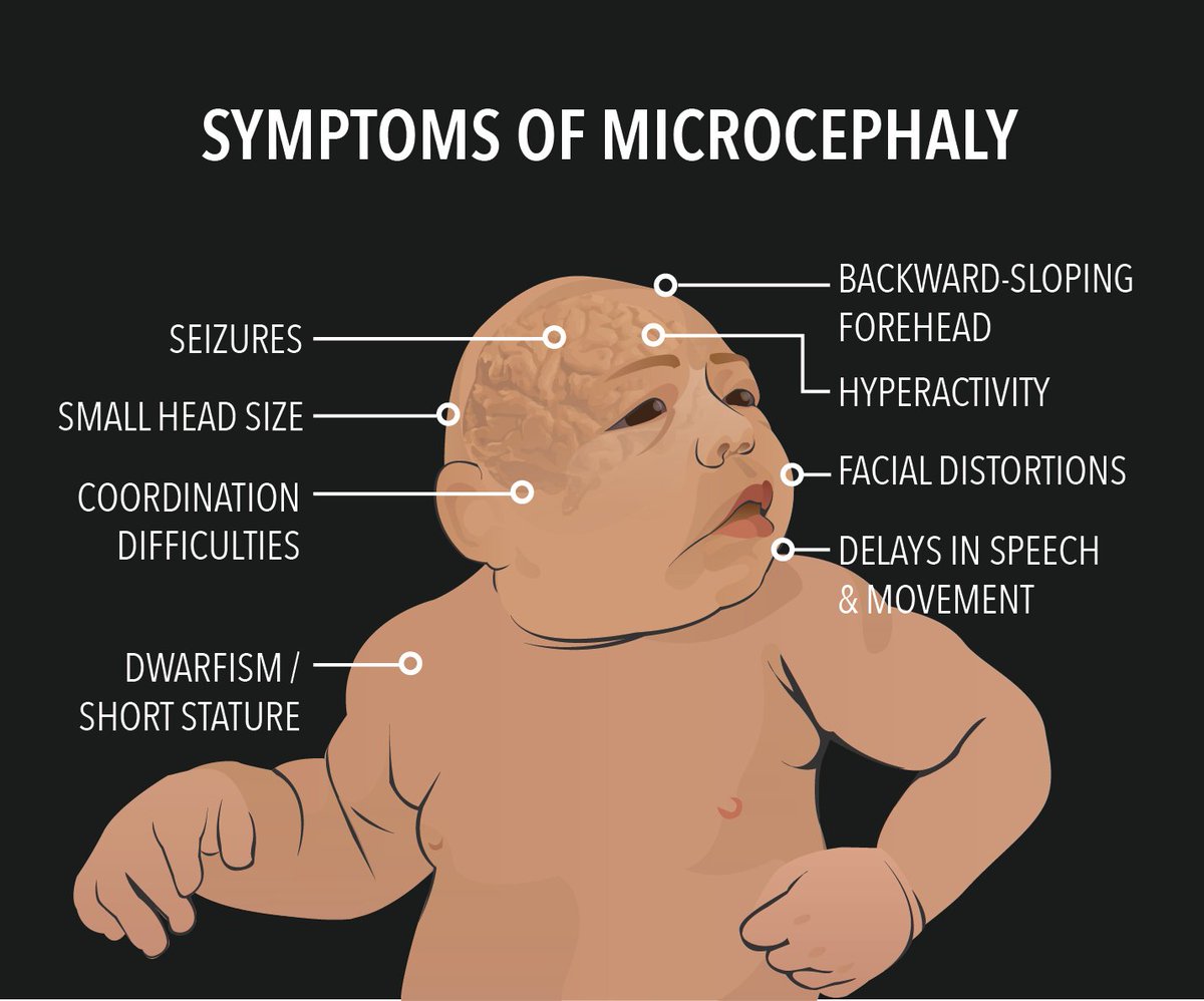 @IhabFathiSulima ✅Microcephaly✅

Congenital Causes--

➡️Genetic Factors✅
➡️Infections during Pregnancy✅
➡️Alcohol and Drug Exposure✅
➡️Radiation Exposure✅
➡️Maternal Malnutrition✅

Acquired Causes-

➡️Infections✅
➡️Head Trauma✅
➡️Metabolic Disorders✅
➡️Toxic Exposure✅
➡️Stroke✅