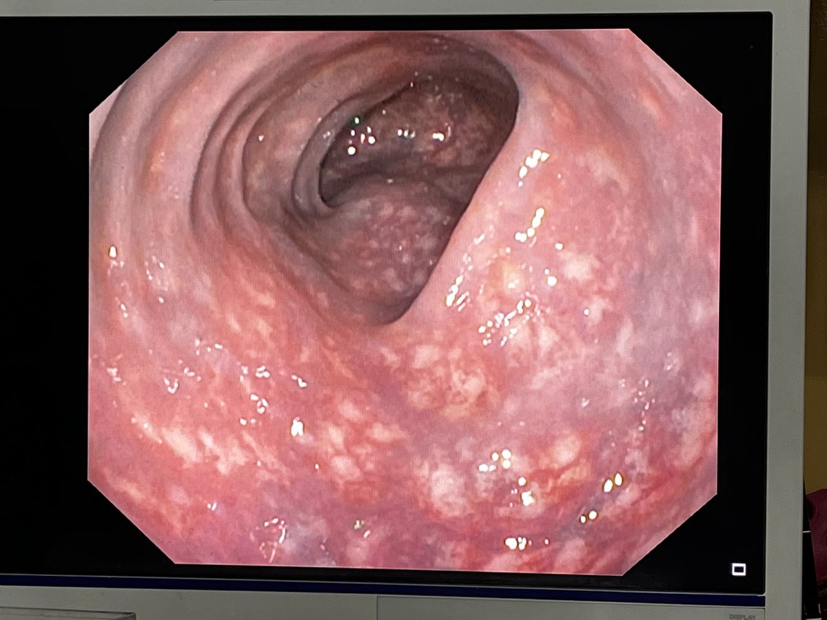 drthusharadw's tweet photo. This patient was diagnosed with UC and defalted treatment for 5 years. Colonoscopy-rectum and sigmoid shows some finding like this.. what could be this and reason? Currently patient is asymptomatic @pramodhchan @drkeithsiau @EndoCollabcom #MedTwitter https://t.co/TPCe3ZHPzm