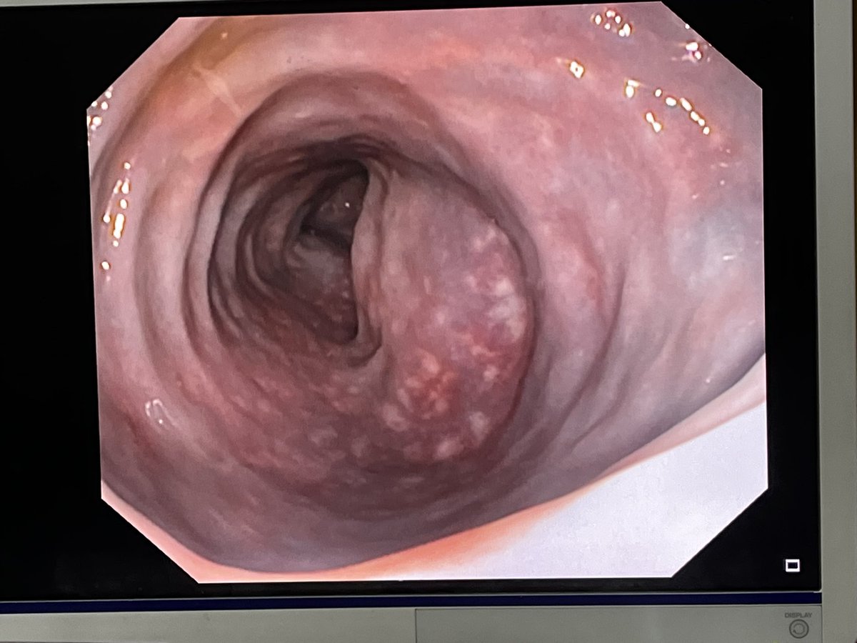drthusharadw's tweet photo. This patient was diagnosed with UC and defalted treatment for 5 years. Colonoscopy-rectum and sigmoid shows some finding like this.. what could be this and reason? Currently patient is asymptomatic @pramodhchan @drkeithsiau @EndoCollabcom #MedTwitter https://t.co/TPCe3ZHPzm
