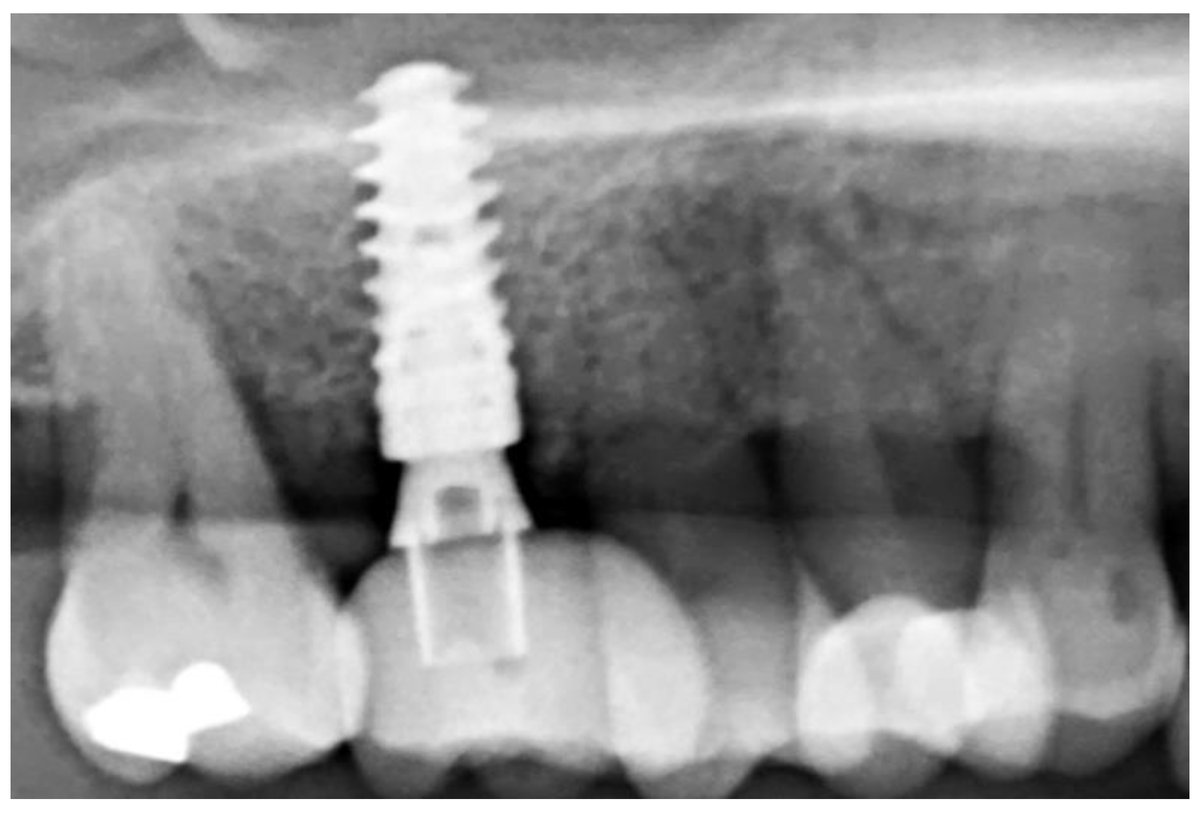 DentistryJ's tweet image. #mdpidentistry
#Tooth-Derived Granules in Combination with Platelet-Rich Fibrin (“Sticky Tooth”) in #Socketpreservation: A Histological Evaluation
@UniBonn @UniWH
mdpi.com/2304-6767/10/2…
#dentingraft #PRF #alveolarridge #bone
@MDPIOpenAccess @MediPharma_MDPI @DentistryJ