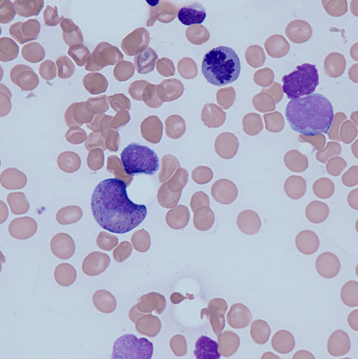 To complete the story, here are the characteristic slender Auer rods and cytoplasmic granules. Yes, this is AML t(8;21)!