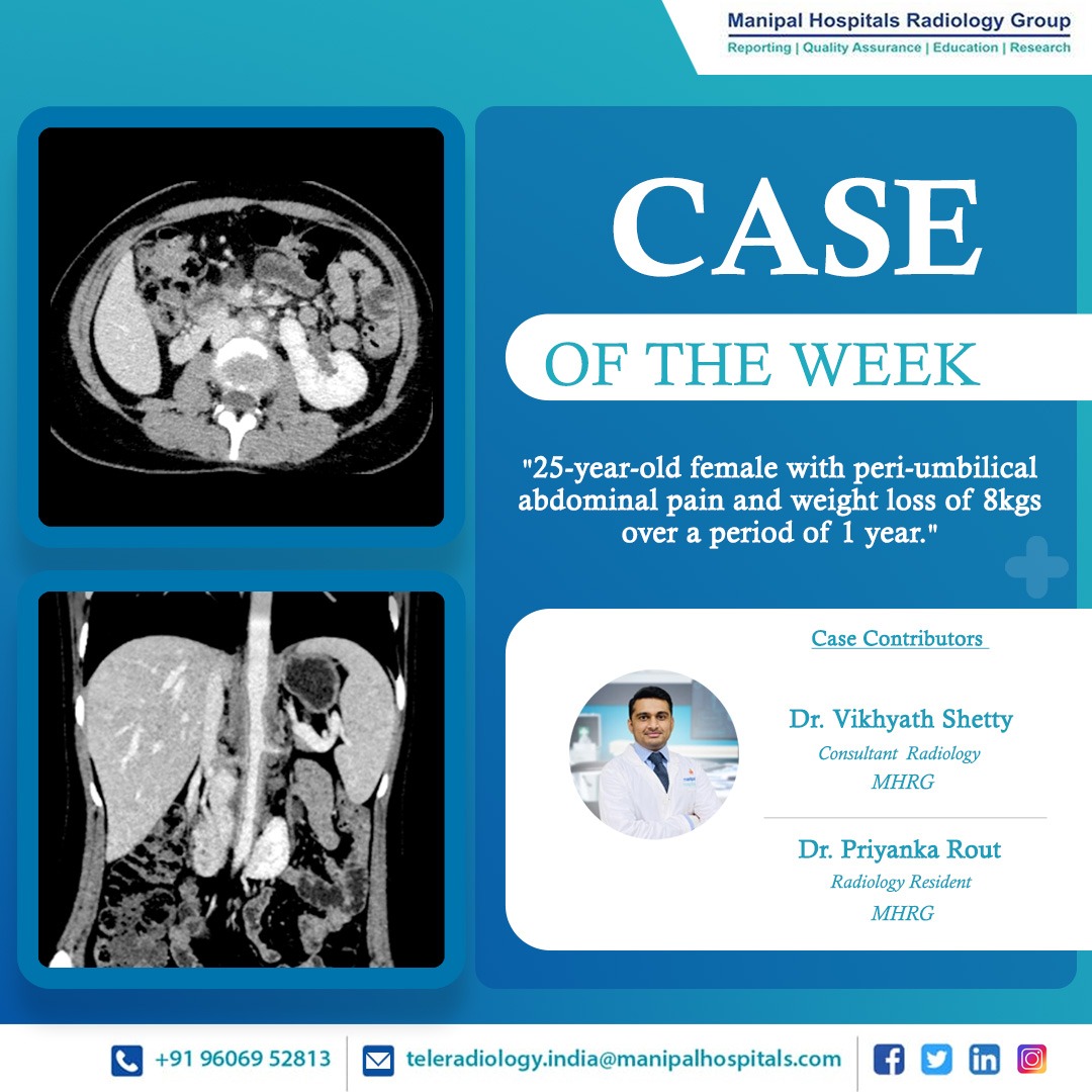 ManipalMhrg's tweet photo. Presenting our #CaseOfTheWeek -   25-year-old female with peri-umbilical abdominal pain and weight loss of 8kgs over a period of 1 year.

Know more: https://t.co/p0JDLFmCIj

#radiologyy #teleradiology #MHRG https://t.co/wvb75FbX9X
