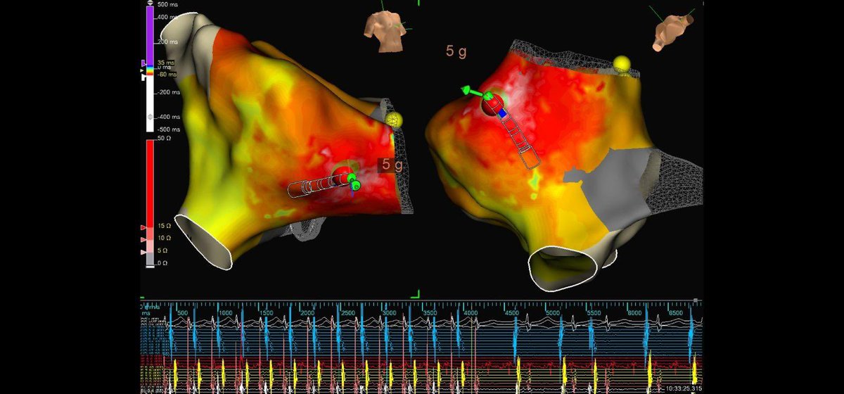 CsZaiger's tweet photo. ~200bpm short rp on 12L. Prior AVNRT ablation. Initially induced with catheter manipulation. Tough time sustaining tach, but #hdgrid &amp; OT bracketed. Tach initiated on ablation, #TactiFlex said I’ll take care of that. Awesome therapy by @dskumarmd and mapping by @kbarker757 https://t.co/Xi2ttgqauO