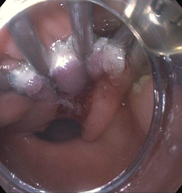 Erik Holzwanger, MD, ABOM-D (@hilarholzy) on Twitter photo Excited to share the start of the endoluminal surgery program <a href="/TuftsMedicalCtr/">Tufts Medical Center</a> with the first ESD and G-POEMs done 🚀
Blessed for my amazing mentors <a href="/BIDMC_GI/">BIDMC_GI</a> for all their teaching <a href="/MoamenGabrMD/">Moamen Gabr</a> <a href="/tberzin/">Tyler Berzin MD, FASGE</a> <a href="/Boston_Endo/">Douglas Pleskow</a> <a href="/MSawhneyMD/">Mandeep Sawhney</a>
<a href="/DrSaeeeed/">Ahmed Saeed, MD, DABOM</a> <a href="/Taalamri/">Turki AlAmri |تُرْكي عبدالله الْعَمريَّ MD</a> <a href="/docdhir/">vinay dhir</a> <a href="/Samir_Grover/">Samir C. Grover, M.D.</a> Excited to share the start of the endoluminal surgery program <a href="/TuftsMedicalCtr/">Tufts Medical Center</a> with the first ESD and G-POEMs done 🚀
Blessed for my amazing mentors <a href="/BIDMC_GI/">BIDMC_GI</a> for all their teaching <a href="/MoamenGabrMD/">Moamen Gabr</a> <a href="/tberzin/">Tyler Berzin MD, FASGE</a> <a href="/Boston_Endo/">Douglas Pleskow</a> <a href="/MSawhneyMD/">Mandeep Sawhney</a>
<a href="/DrSaeeeed/">Ahmed Saeed, MD, DABOM</a> <a href="/Taalamri/">Turki AlAmri |تُرْكي عبدالله الْعَمريَّ MD</a> <a href="/docdhir/">vinay dhir</a> <a href="/Samir_Grover/">Samir C. Grover, M.D.</a>