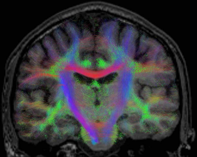 An MRI scan for the BRAIN-DTI experiment using tractography to show neural networks.

Credits: B. Jeurissen

#MedTwitter #neuroscience