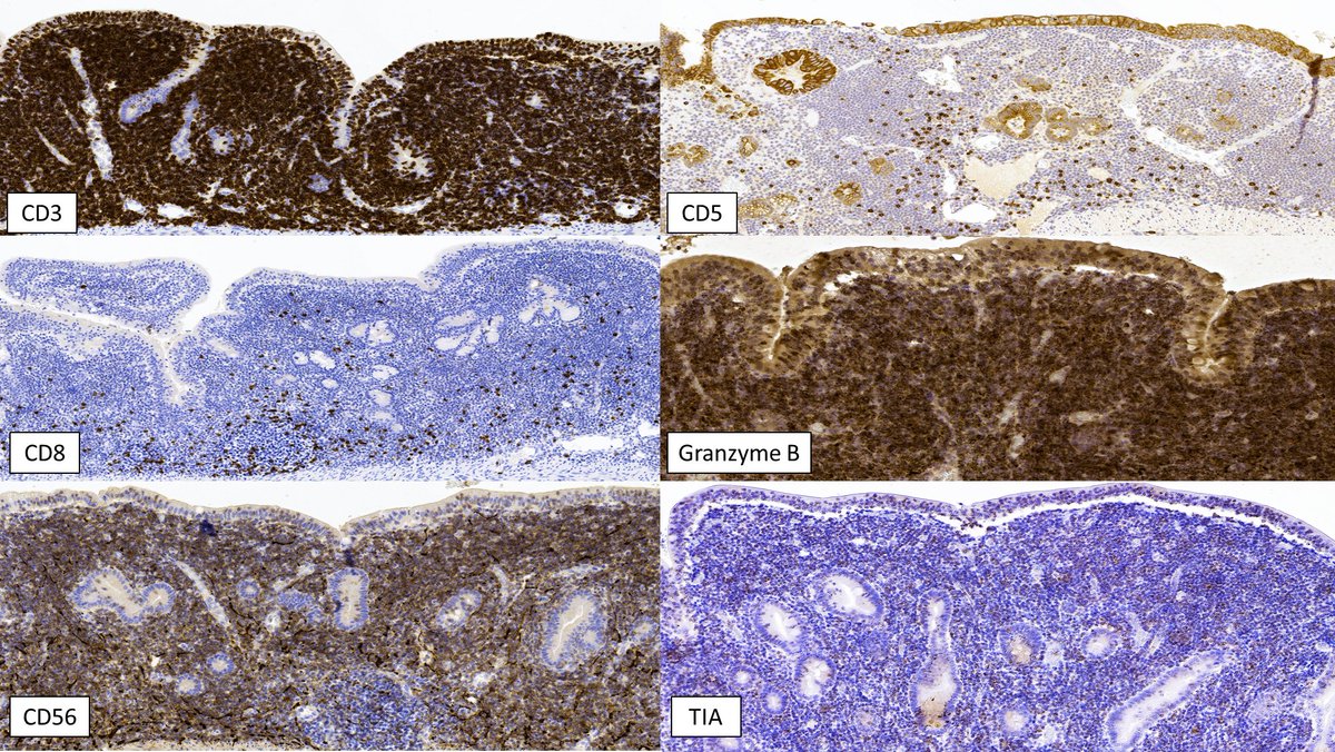 Most monomorphic epitheliotropic intestinal T-cell lymphoma (MEITL) cases are CD8+; However, 10-20% can be CD8- like case below #Lymsm #GIpath #surgpath #PathTwitter #MedTwitter