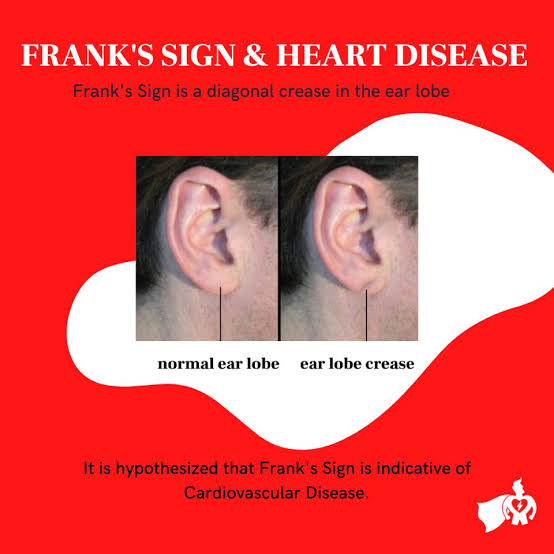 @drkeithsiau Frank sign/crease/Diagonal earlobe crease (DELC) is a ...