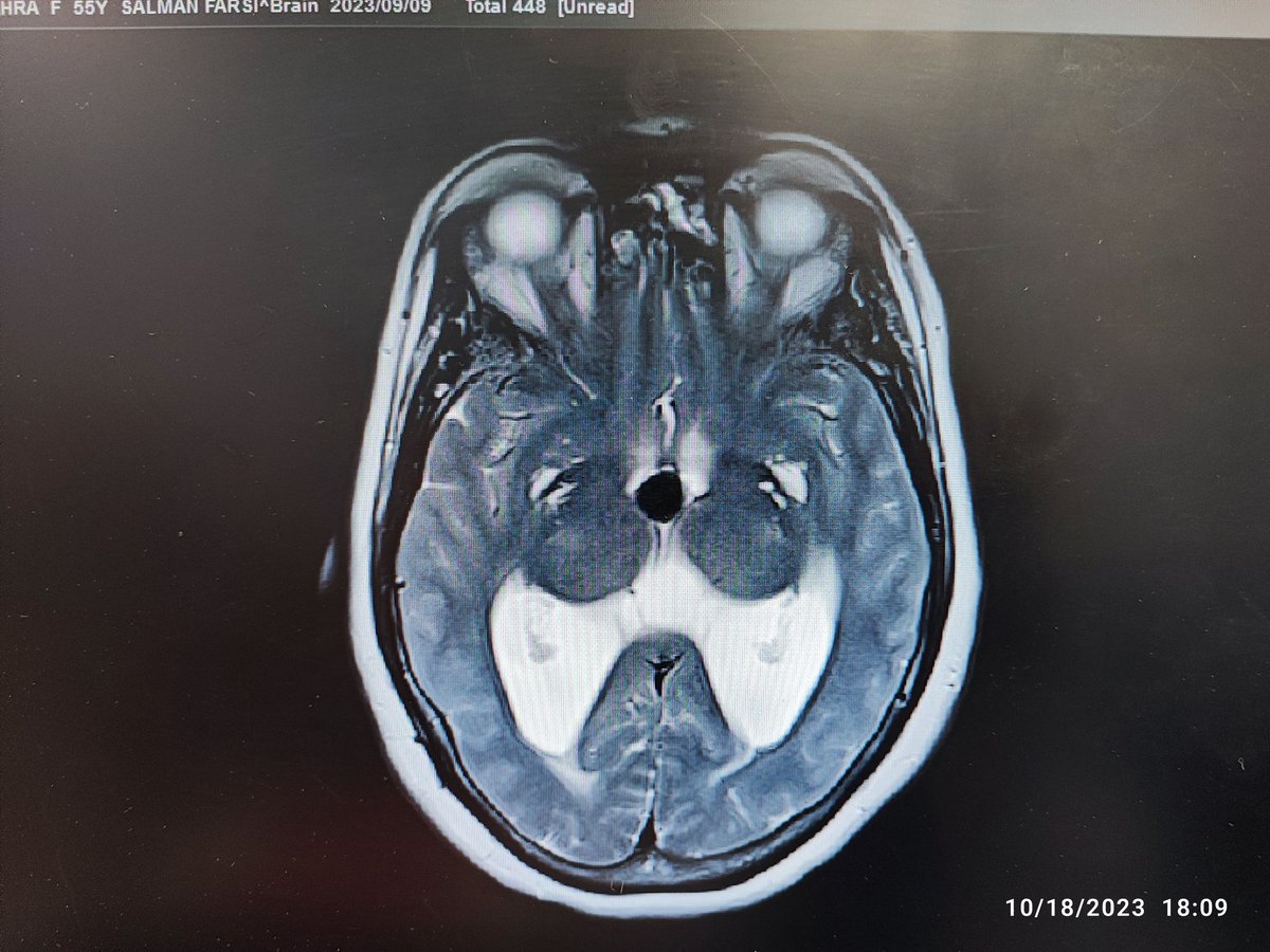 mo_ma1374's tweet photo. The case we are presenting is that of a 55 Y/O woman with no PMH, GCS 15/15, and a mild headache. The radiological features seemed to be consistent with a colloid cyst, which is widely known to cause obstructive hydrocephalus. Instead of anticipated colloid cyst, keratin pearl... https://t.co/xECHL2eJMK