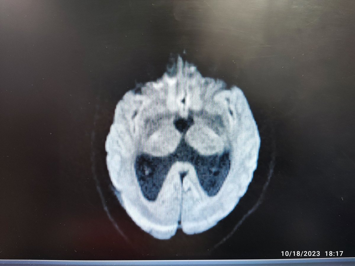 mo_ma1374's tweet photo. The case we are presenting is that of a 55 Y/O woman with no PMH, GCS 15/15, and a mild headache. The radiological features seemed to be consistent with a colloid cyst, which is widely known to cause obstructive hydrocephalus. Instead of anticipated colloid cyst, keratin pearl... https://t.co/xECHL2eJMK