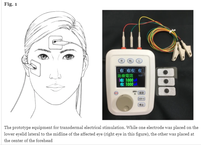 'Efficacy and safety of transdermal electrical stimulation in patients with nonarteritic anterior ischemic optic neuropathy' by G. Miura et al. #BioelectronicMedicine #TdES #NAION #OpticNeuropathy bioelecmed.biomedcentral.com/articles/10.11…