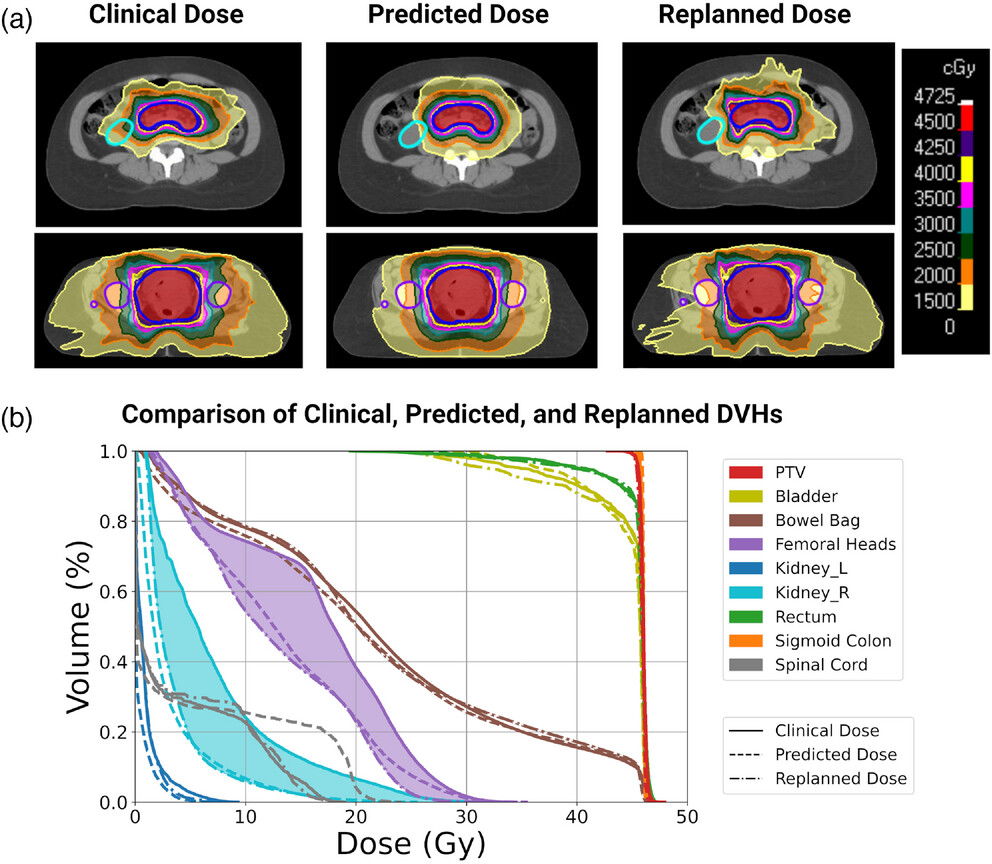 What are the potential clinical gains of AI dose prediction? Through collaboration with a GYN #radonc @MDAndersonNews, we showed that dose prediction can identify suboptimal plans and guide plan re-optimization to improve plan quality. @LaurenceECourt doi.org/10.1002/mp.167…