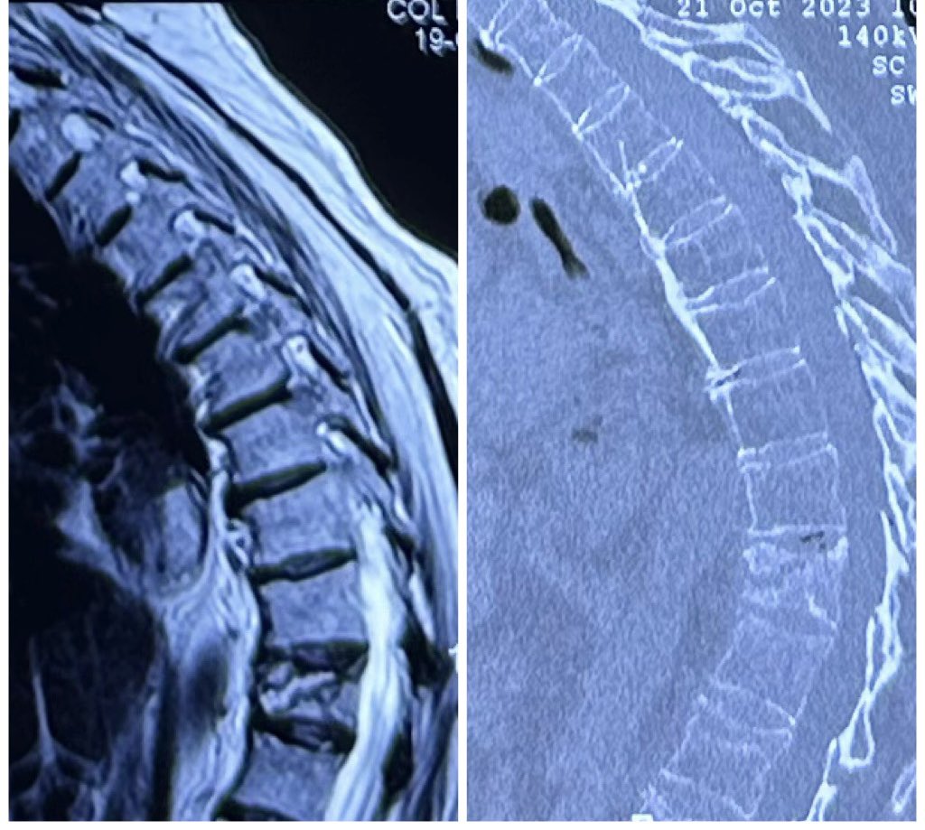 pterion77's tweet photo. Paciente de 70 años con fractura por osteoporosis de T11, realizamos un procedimiento corto y sencillo de VERTEBROPLASTIA @pablopenatapia @HospitaldelRio #vertebroplastia #fractura #spine #osteoporosis https://t.co/oXUUtvdgrI