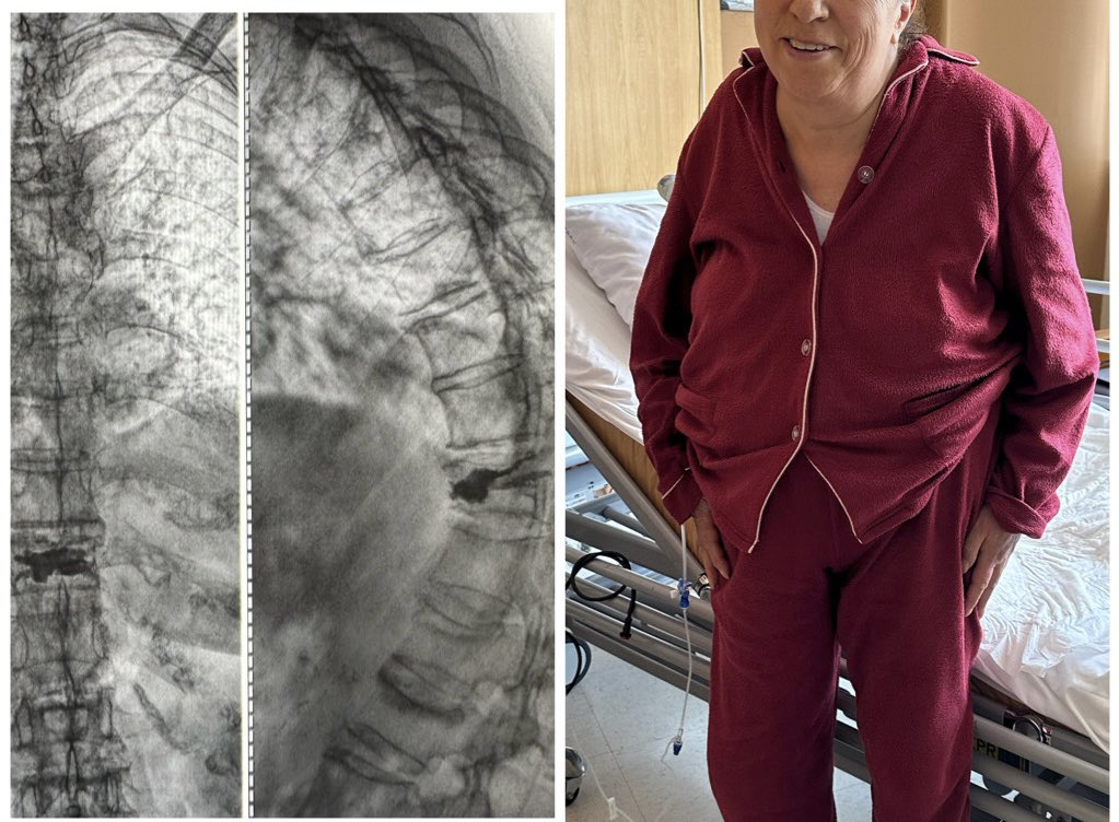 pterion77's tweet photo. Paciente de 70 años con fractura por osteoporosis de T11, realizamos un procedimiento corto y sencillo de VERTEBROPLASTIA @pablopenatapia @HospitaldelRio #vertebroplastia #fractura #spine #osteoporosis https://t.co/oXUUtvdgrI