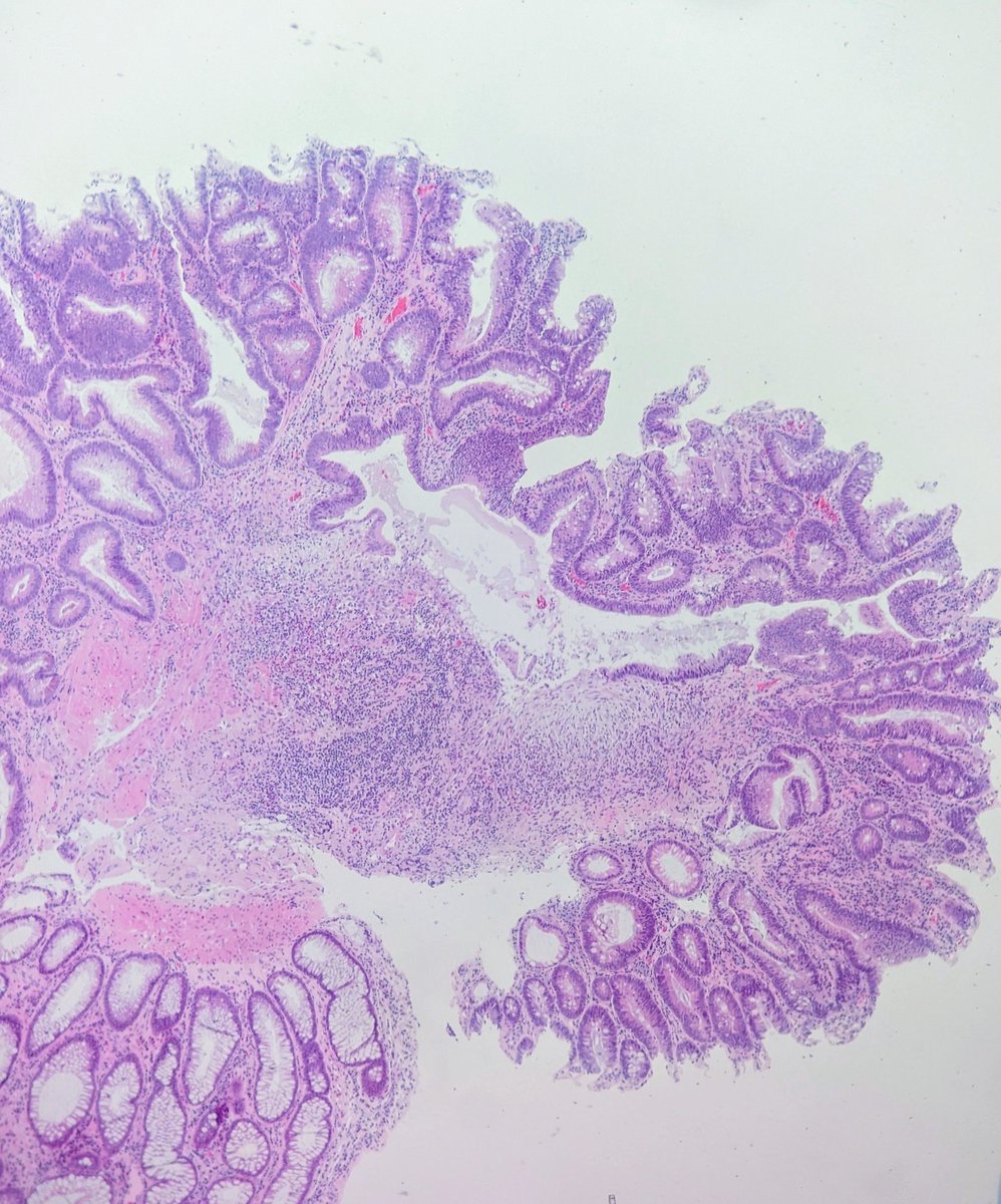 w_path's tweet image. Sigmoid polyp.  Dysplasias vs. Fibrosis 2nd to ruptured crypt .  How reproducible is desmoplastic reaction? #gipathology #patholo