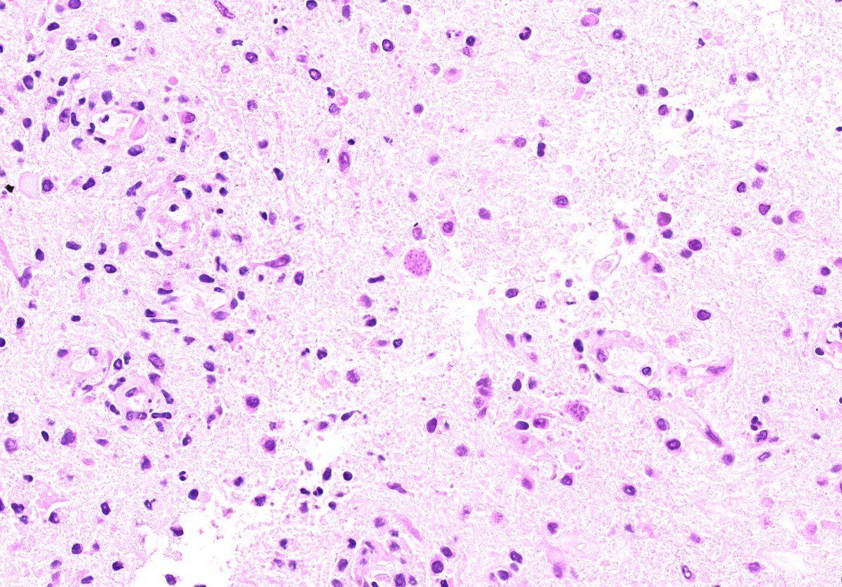 TristanRutland7's tweet image. Brain

(No Hx).

#neuropath #IDpath #Medtwitter #pathresidents #pathtwitter #pathX