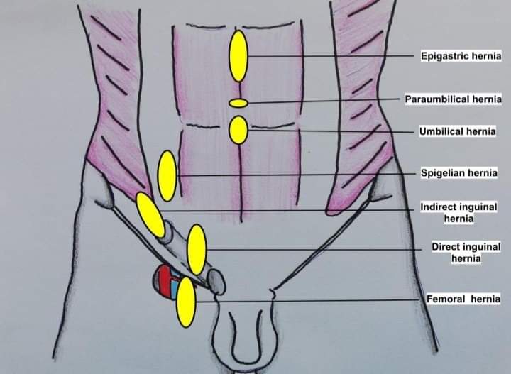 Types of abdominal wall hernia!!
#SoMe4IQLatAm #SoMe4Surgery #MedTwitter #GITwitter