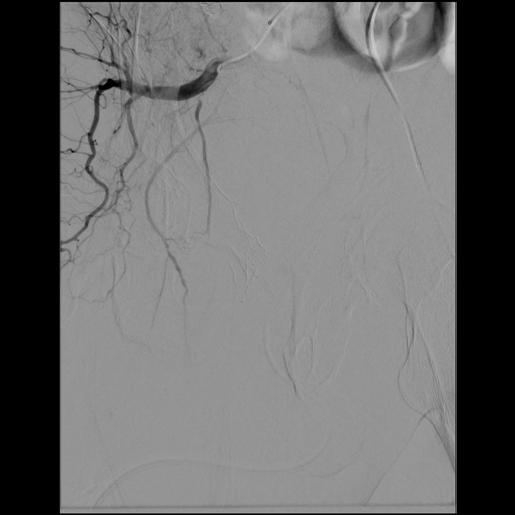 First day with LAVA-18 and it was quite the day. Our first case was a hypotensive patient with a pelvic fracture and active bleeding (with the LAVA coming off the delivery truck right to the angio suite and right into the patient). @SirtexMedical @thegestgroup