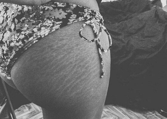 Facts about girls with stretch marks .💯