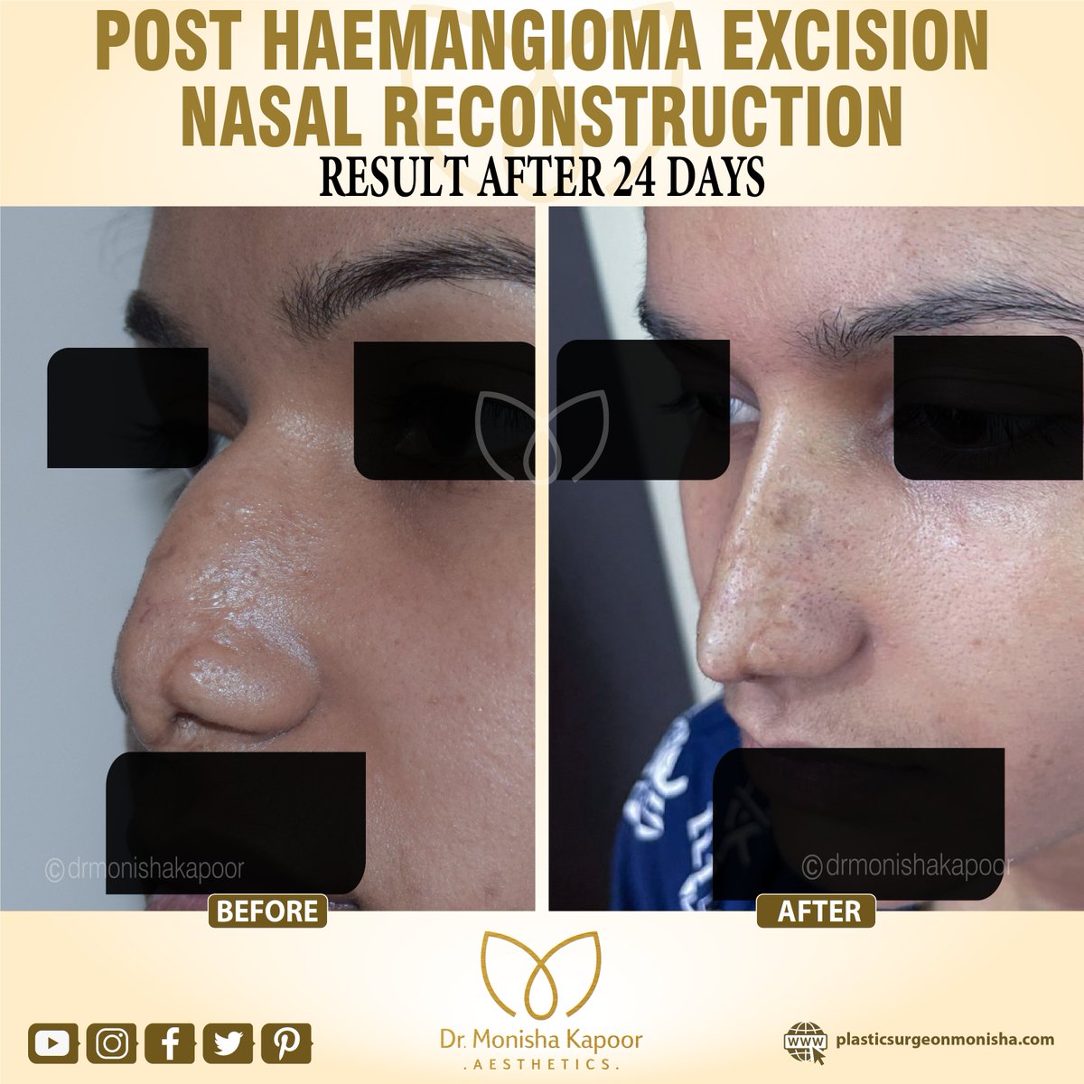 'Post- #hemangioma Excision Nasal Reconstruction'
plasticsurgeonmonisha.com/face/nose/
#rhinoplasty #reconstructivesurgery #hemangioma #ribcartilage #beforeandafter #cosmeticsurgery #plasticsurgery #lifechangingsurgery #facialreconstruction