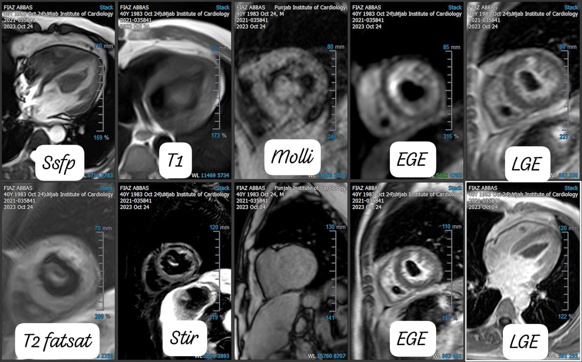 40 y male 
Biventricular masses.
History of vericose veins with ulceration. Pre op echo showed mass. Referred for cmr.
Any thoughts. <a href="/cshenoy3/">Chetan Shenoy</a>
<a href="/SabhaBhatti/">Sabha Bhatti MD</a> <a href="/alexsfelixecho/">Alex Felix</a>