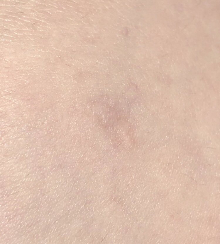 VinegaredKelp's tweet image. 太もも脂肪吸引の
👈テーピングさぼった傷跡(だいぶ目立つ)
👉ちゃんとしてた方の傷跡(全然わからん)

みんなちゃんとテーピングしましょう